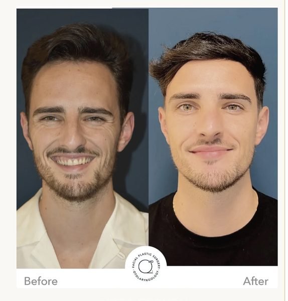 Lorenzo M. — Antes y después rinoplastia Dr. Jorge Duque
